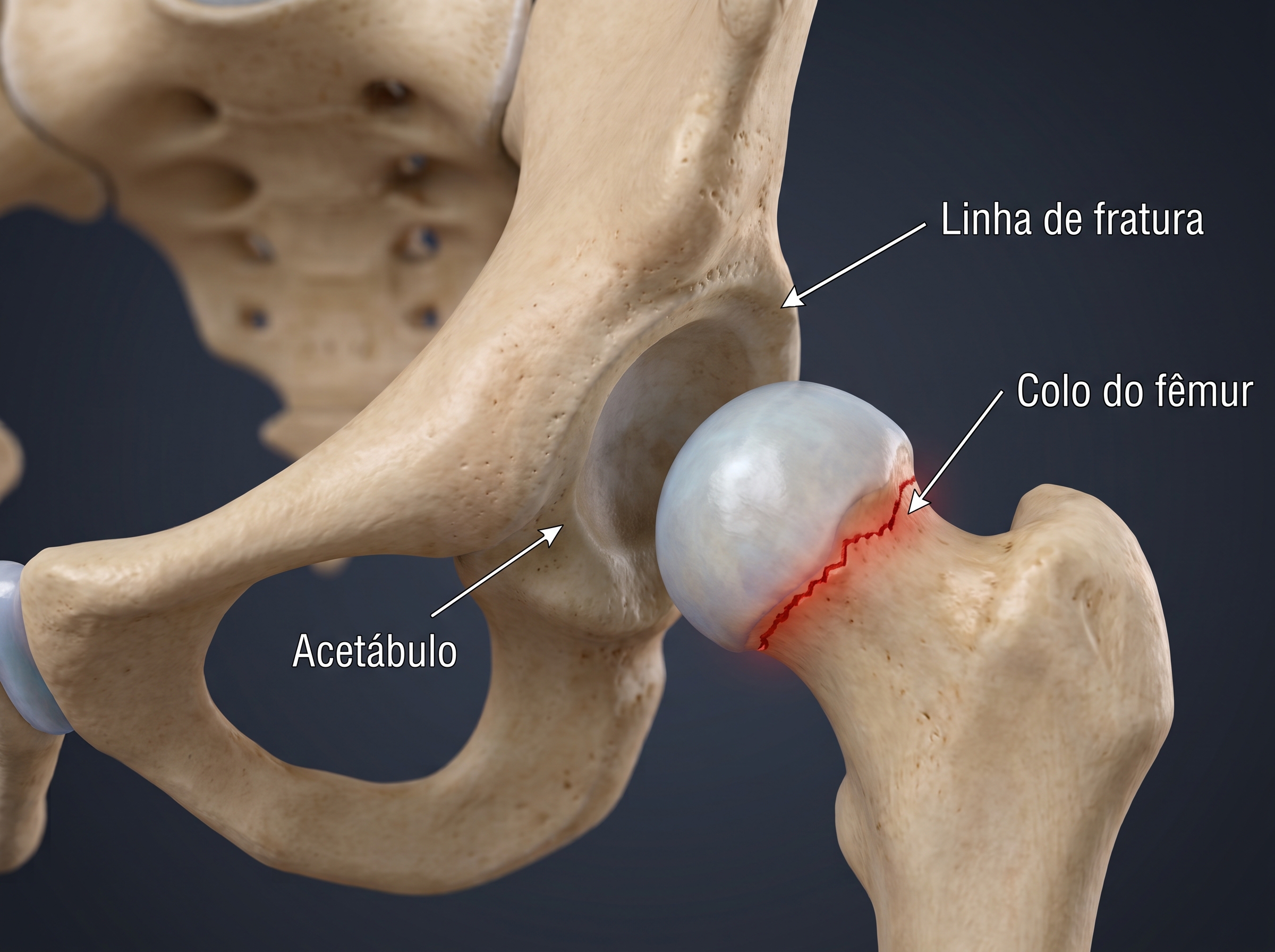 Ilustração de fraturas do quadril, pelve e acetábulo