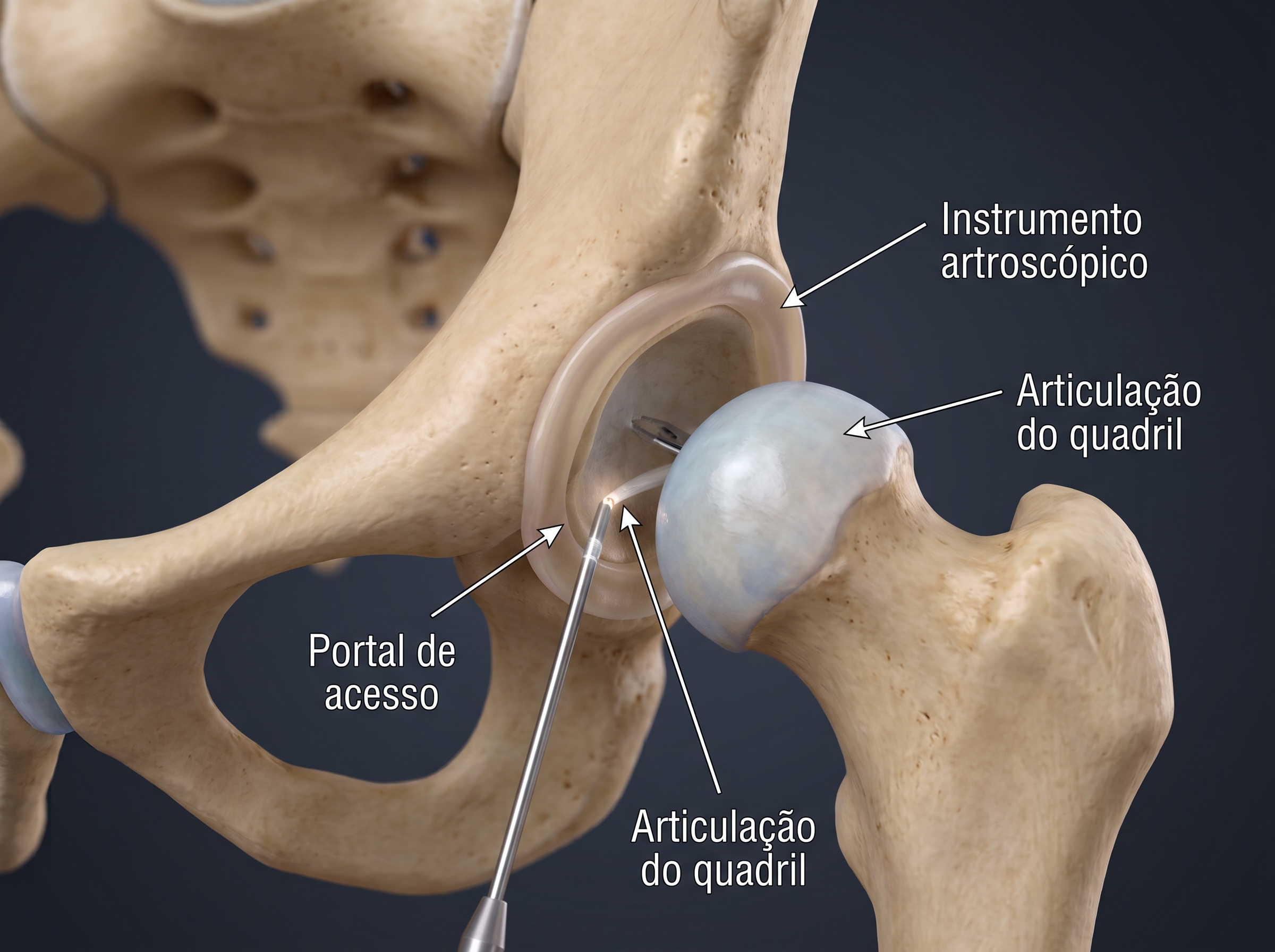 Ilustração da artroscopia do quadril