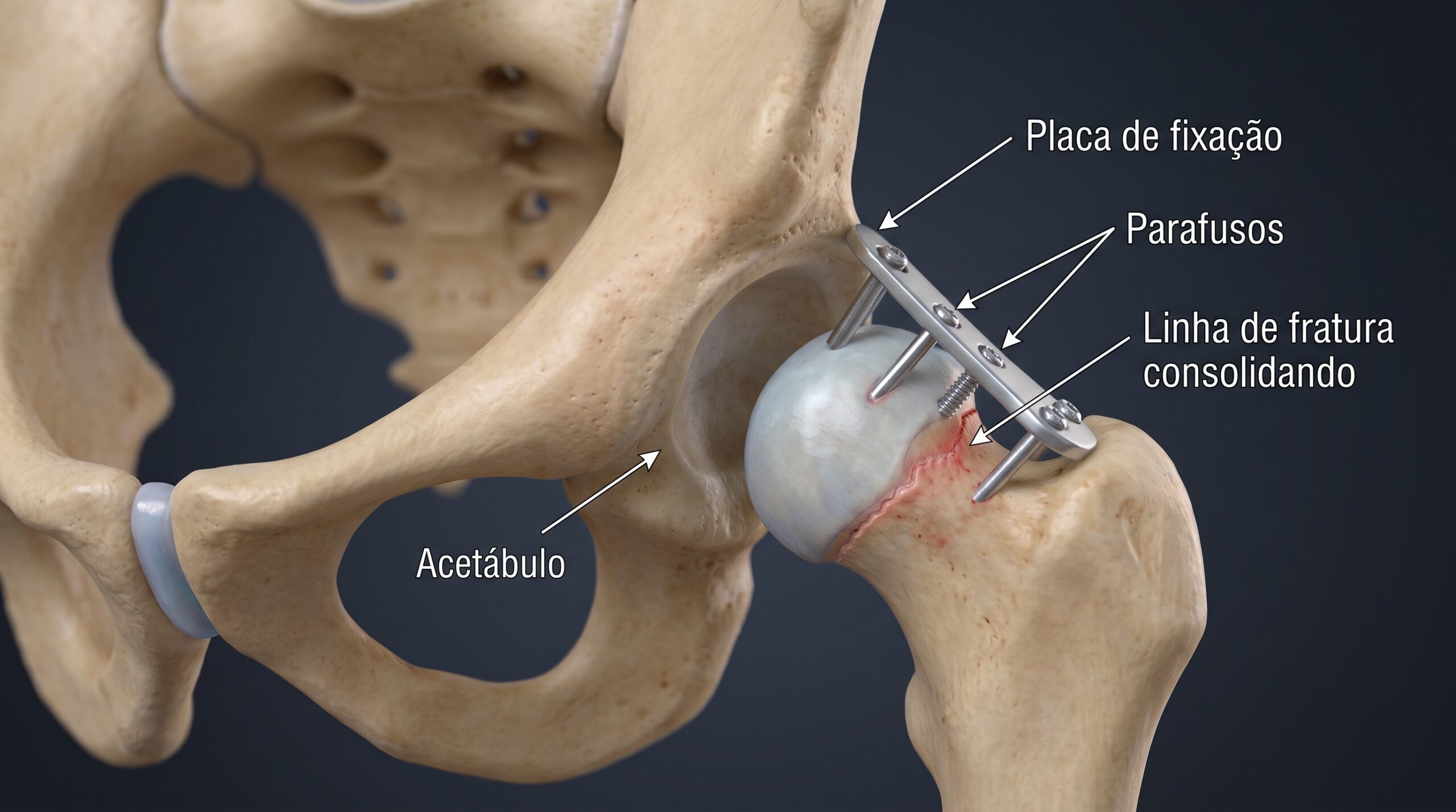 Ilustração da cirurgia de fraturas